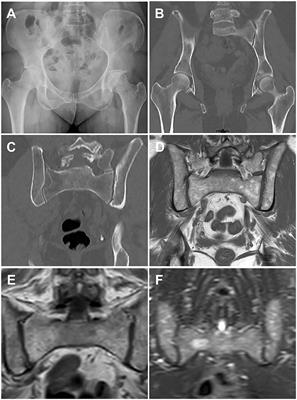 Advanced Imaging of Multiple Myeloma Bone Disease